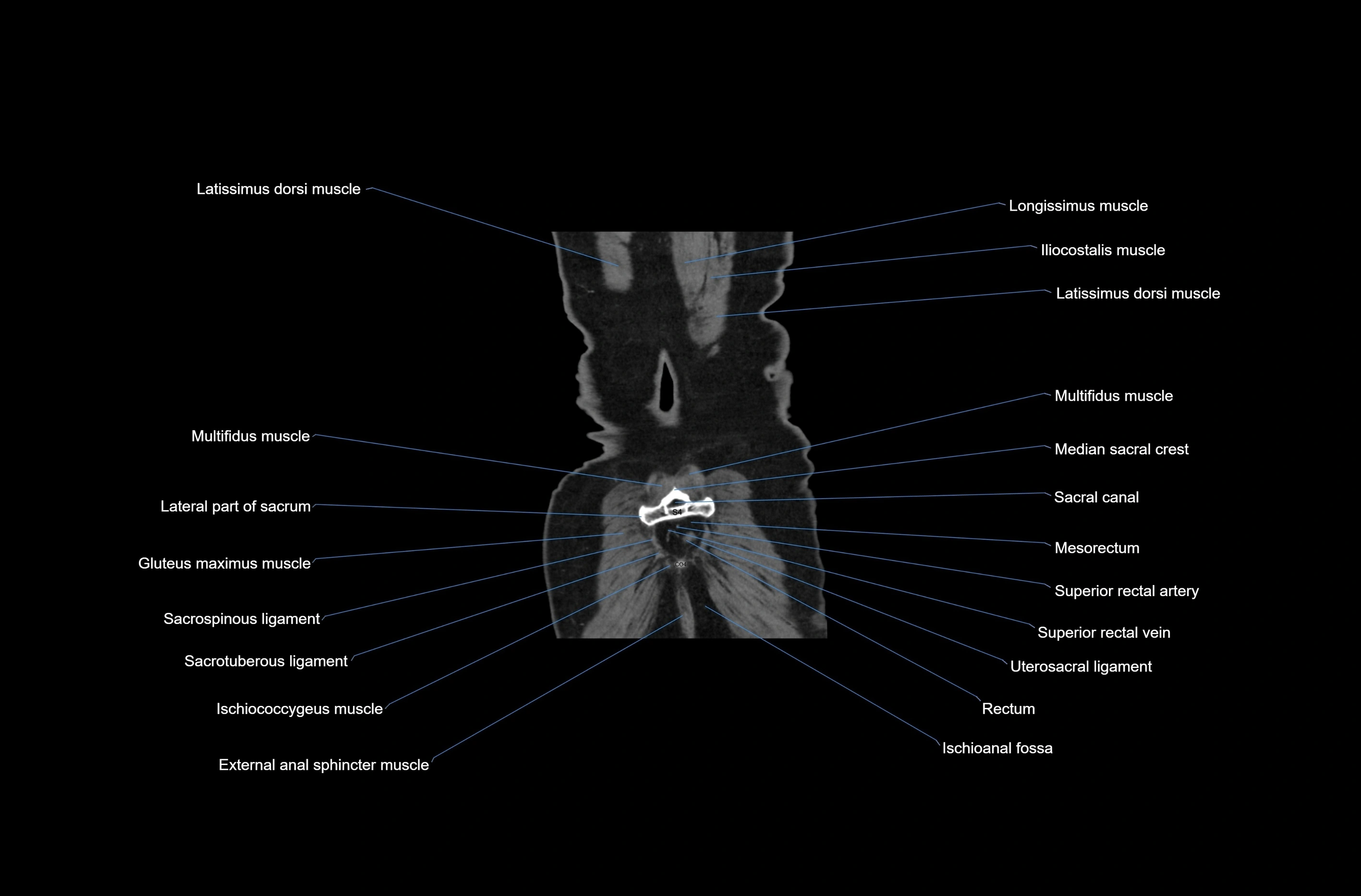 CT abdomen coronal cross sectional anatomy labelled radiology image-00080.webp